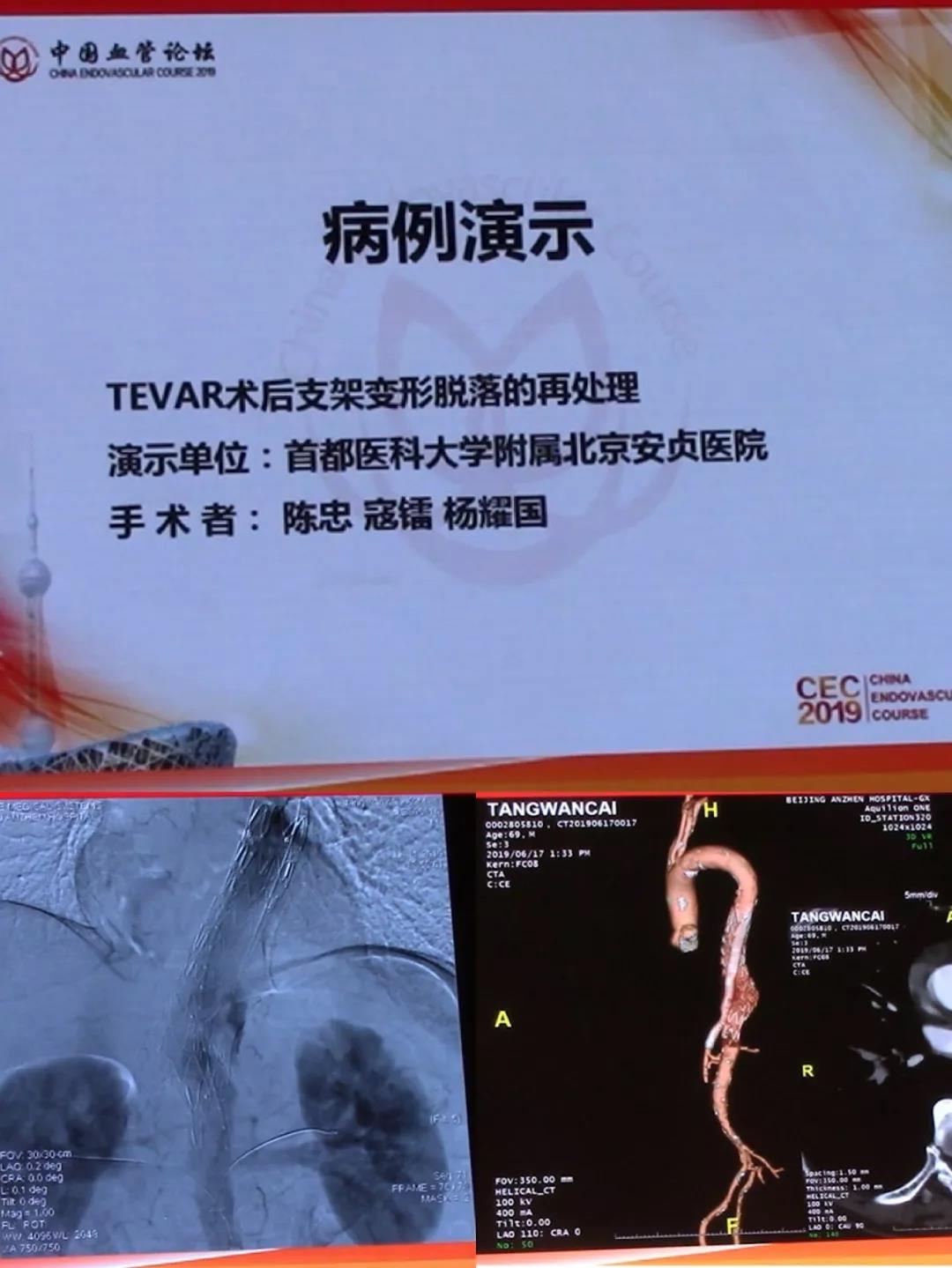 首都醫科大學附屬北京安貞醫院手術錄播《ankura支架在tevar術後支架